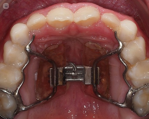 Expansión de Paladar: Mejorando la Salud Bucal y Facial